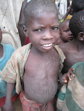 malnourished african